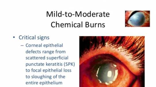 Chemical Burns to the Eye