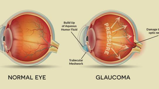 Could you be affected by glaucoma?