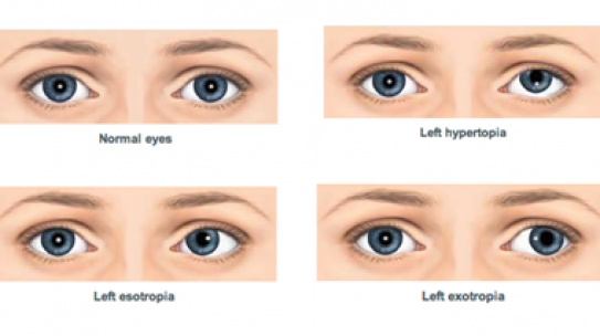 Squint or strabismus treatment.