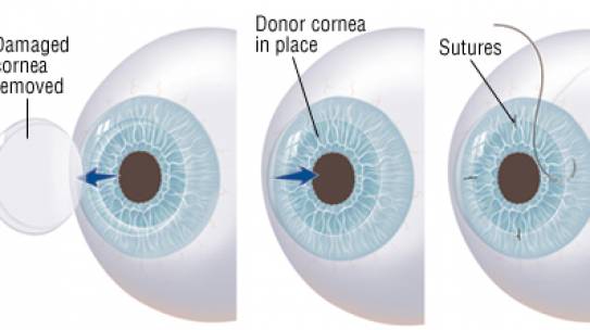 What is a cornea transplant?