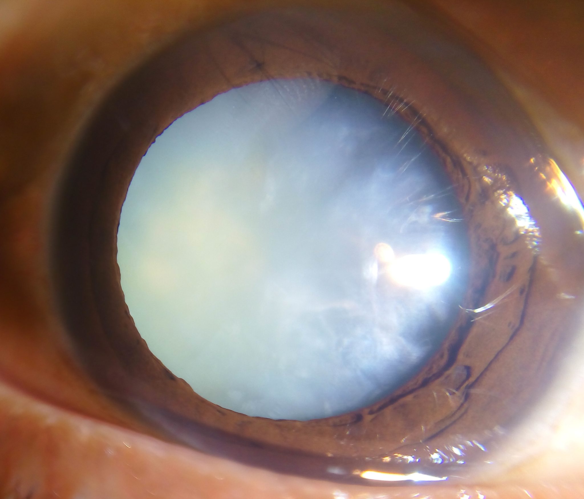 Posterior Subcapsular Cataract The Eye Center Dr Mahnaz Naveed Shah